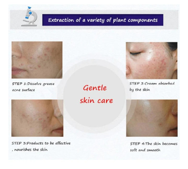 BIOAQUA Anti Acne Cream Acne Scar Removal Cream | Best Quality Scar Removal Cream 30g( Original )